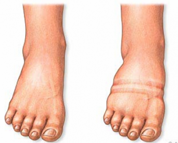 Edema